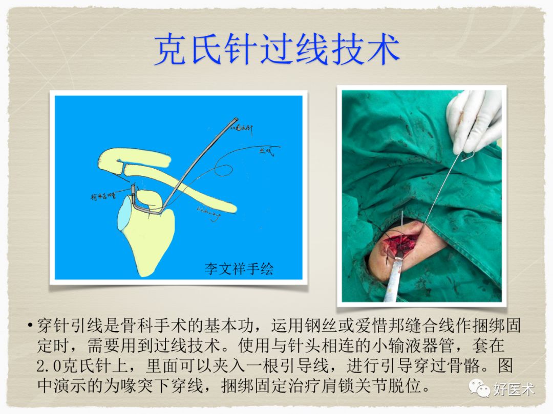 克氏针在骨科手术中的妙用，你Get到了没？