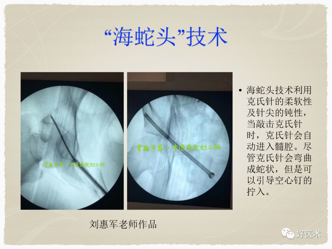 克氏针在骨科手术中的妙用，你Get到了没？