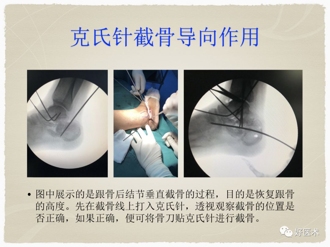 膝盖髌骨骨折图片,髌骨骨折图片,髌骨骨折图片_大山谷图库