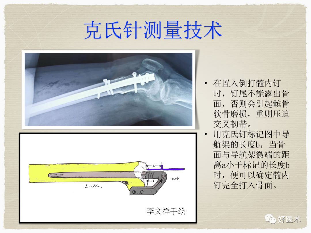 克氏针在骨科手术中的妙用，你Get到了没？