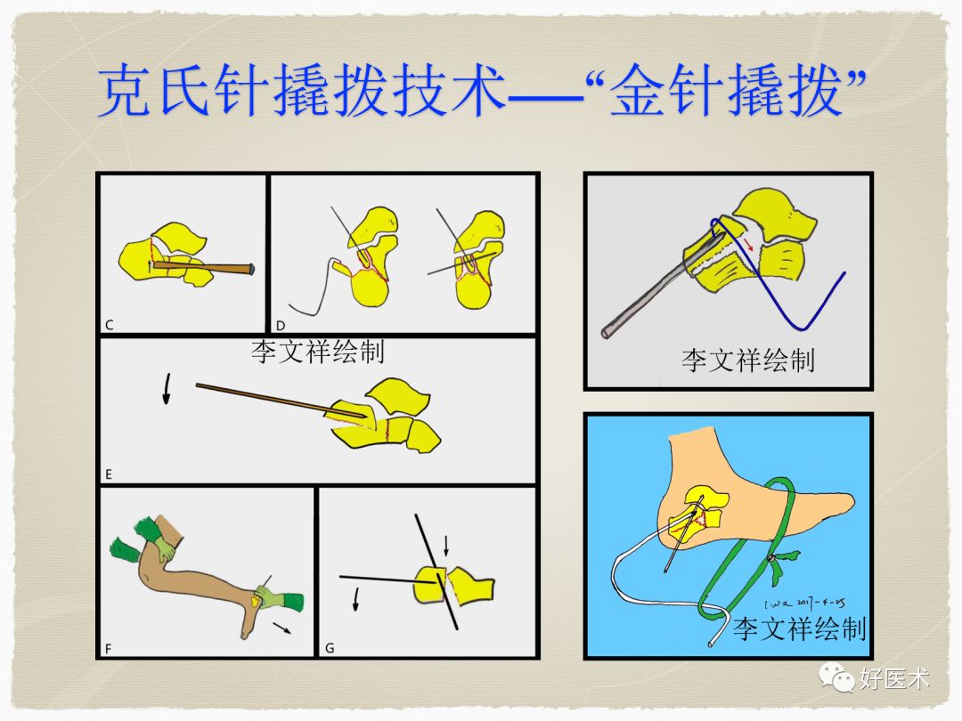 克氏针在骨科手术中的妙用，你Get到了没？