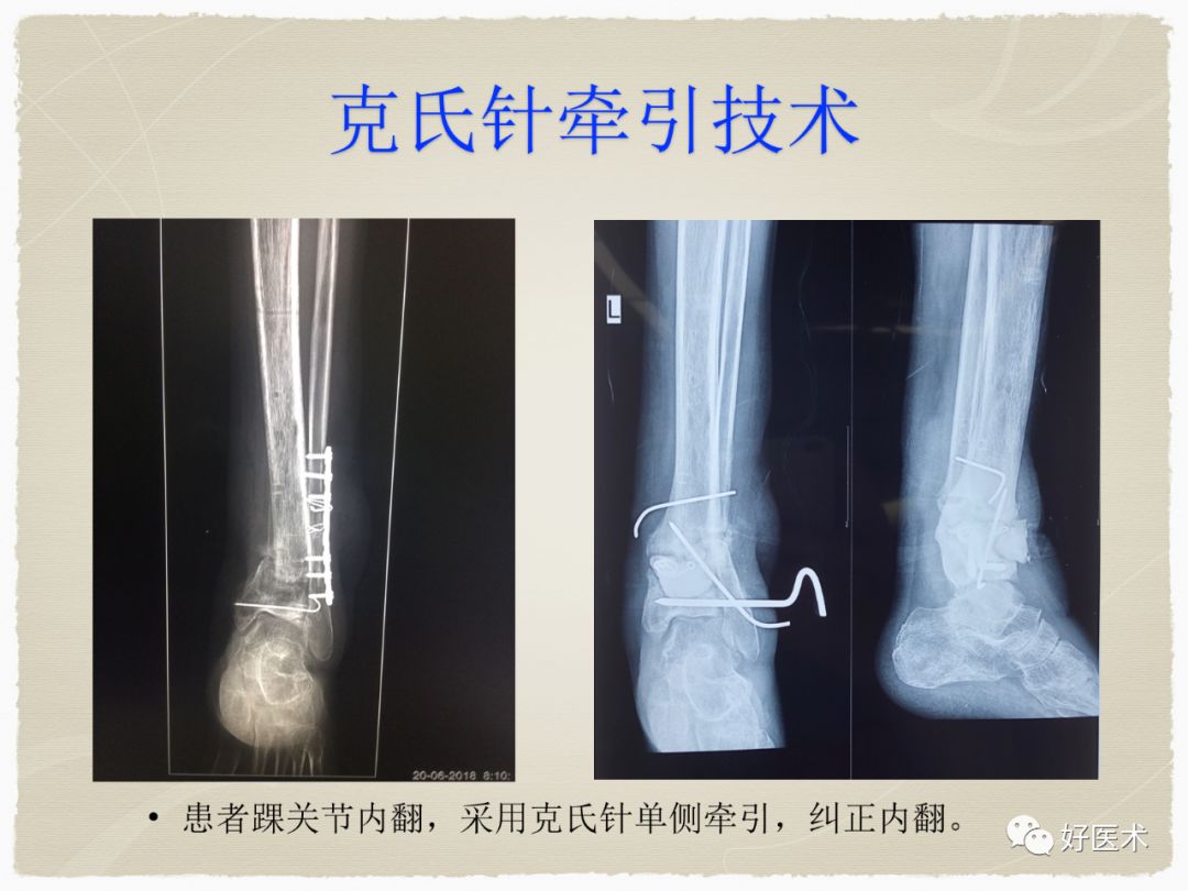 克氏针在骨科手术中的妙用，你Get到了没？