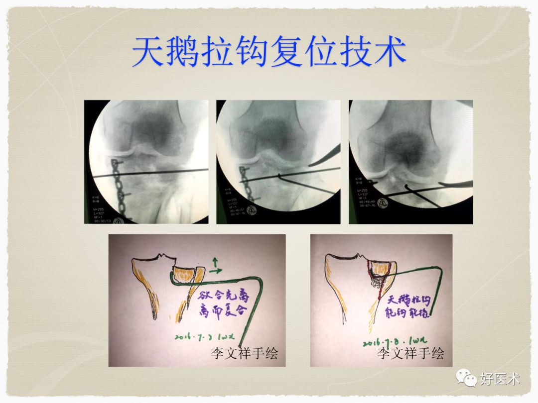 克氏针在骨科手术中的妙用，你Get到了没？