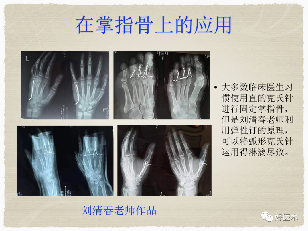 克氏针 - 上海开为医药科技有限公司--创伤、肢体矫形技术解决方案的专业服务商