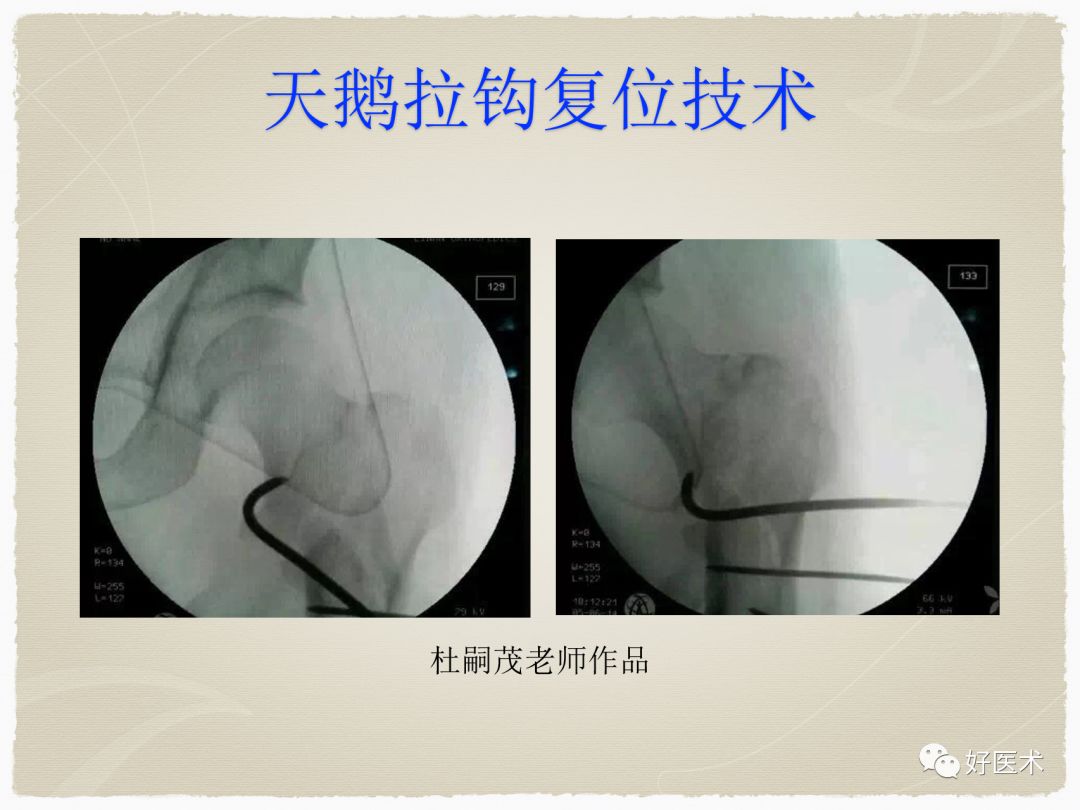 克氏针在骨科手术中的妙用，你Get到了没？