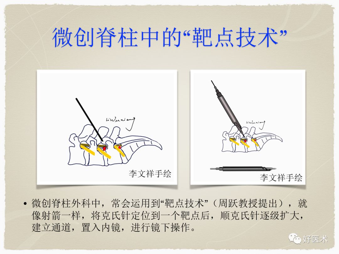 克氏针在骨科手术中的妙用，你Get到了没？