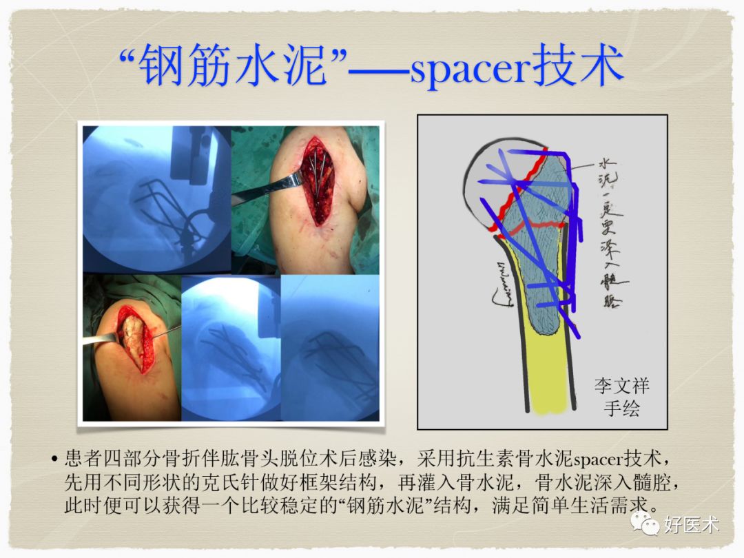 克氏针在骨科手术中的妙用，你Get到了没？