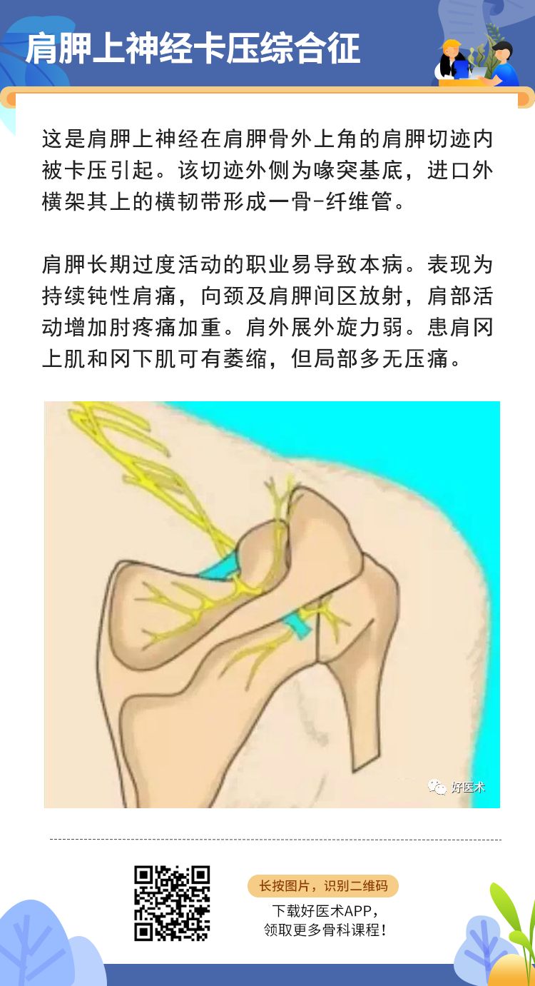 骨科常见周围神经卡压综合征，你都认识吗？