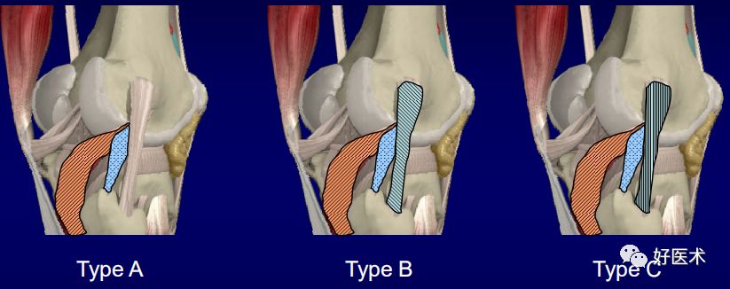膝关节解剖高清图解，基础必备！