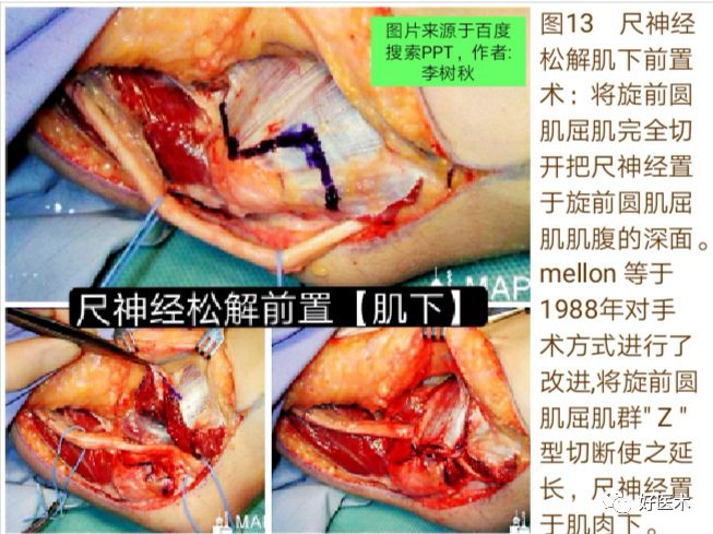 肘管综合征十大要点详解，帮你彻底整明白！