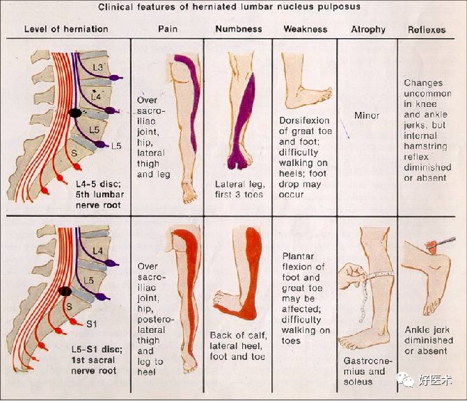 10分钟带您系统学习：腰椎间盘突出症！