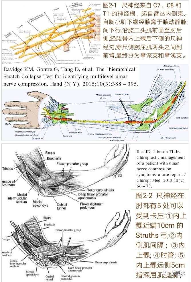 肘管综合征十大要点详解，帮你彻底整明白！