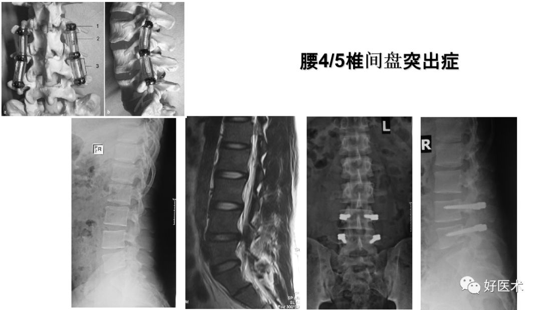 10分钟带您系统学习：腰椎间盘突出症！