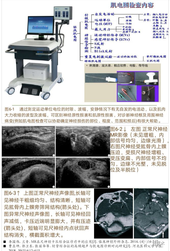 肘管综合征十大要点详解，帮你彻底整明白！