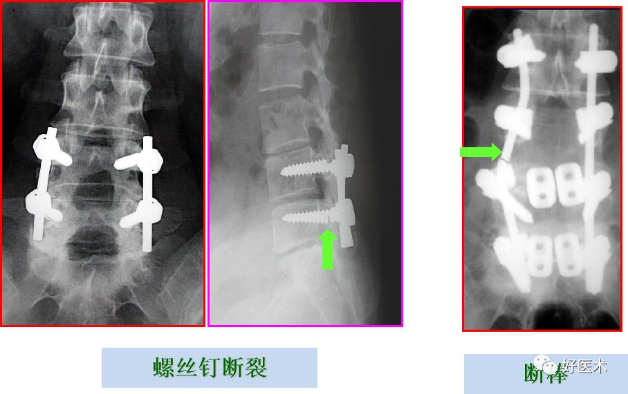 10分钟带您系统学习：腰椎间盘突出症！