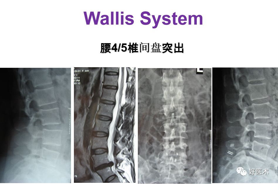 10分钟带您系统学习：腰椎间盘突出症！