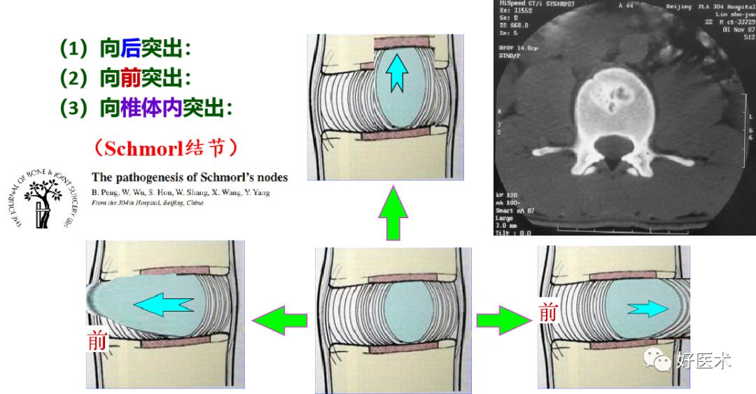 10分钟带您系统学习：腰椎间盘突出症！