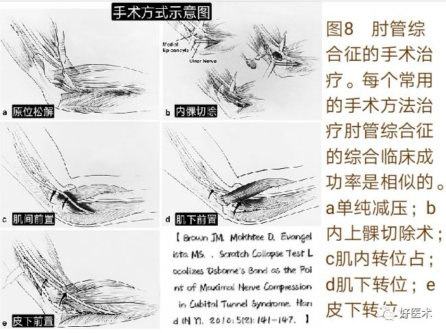 肘管综合征十大要点详解，帮你彻底整明白！