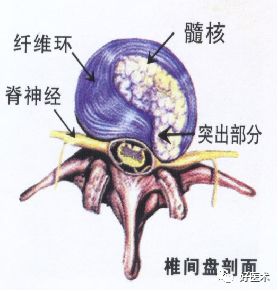 10分钟带您系统学习：腰椎间盘突出症！