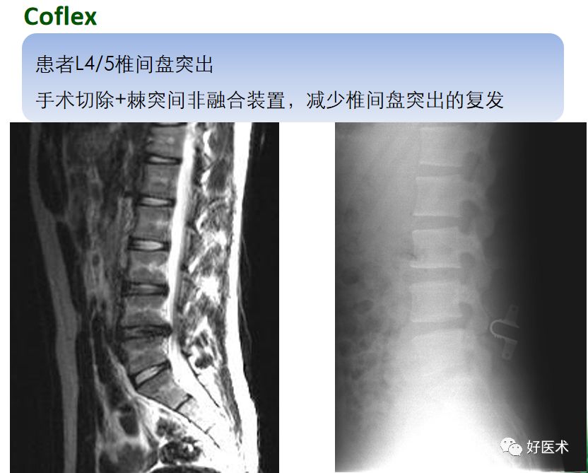 10分钟带您系统学习：腰椎间盘突出症！