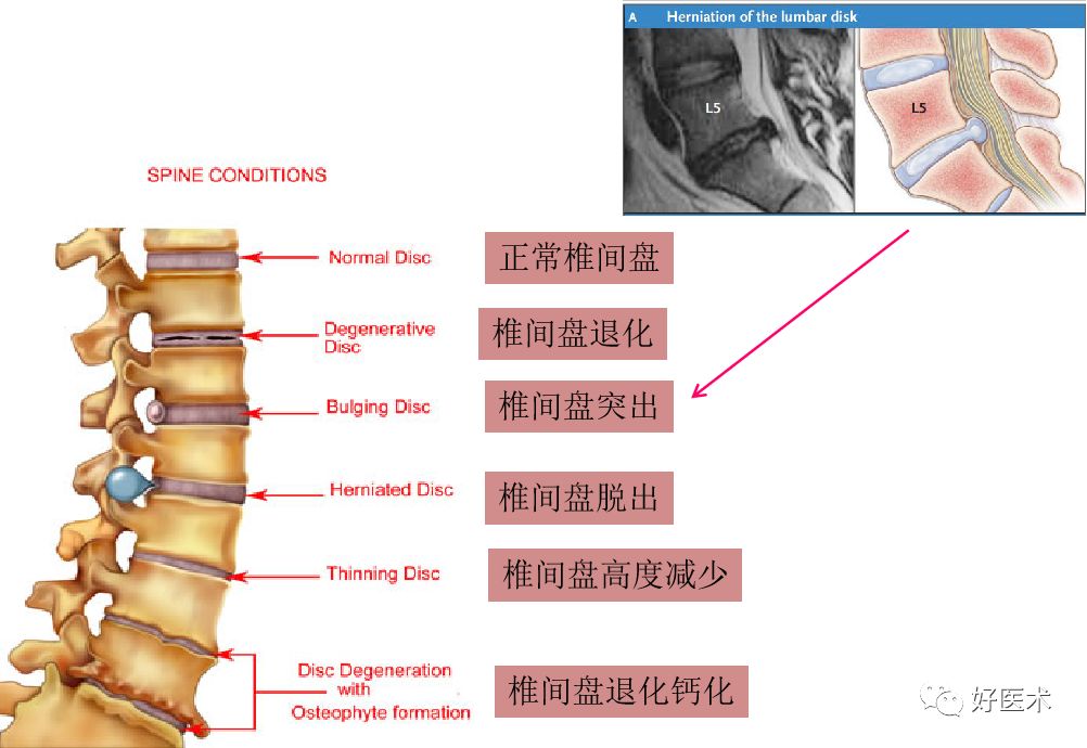 10分钟带您系统学习：腰椎间盘突出症！