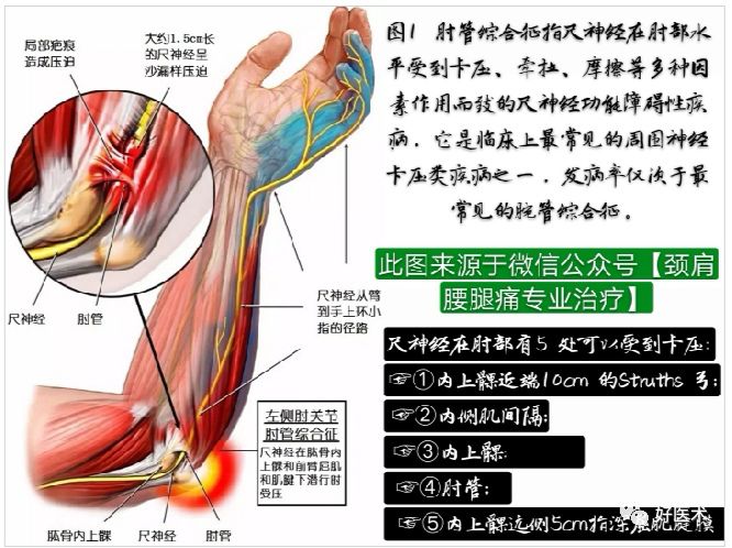 肘管综合征十大要点详解，帮你彻底整明白！