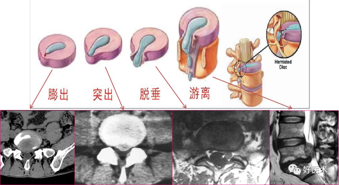 10分钟带您系统学习：腰椎间盘突出症！