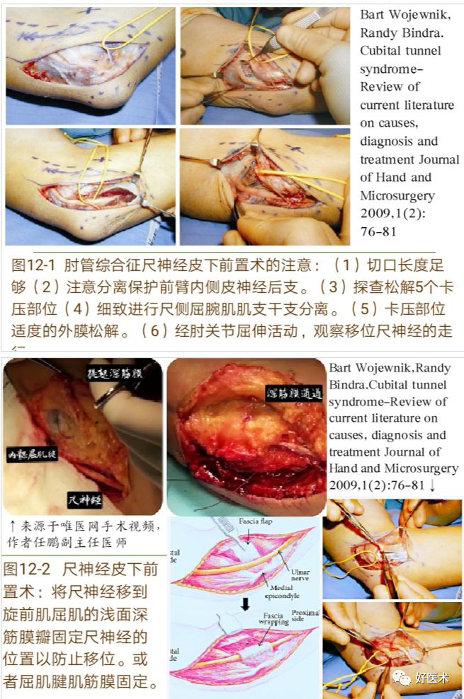 肘管综合征十大要点详解，帮你彻底整明白！