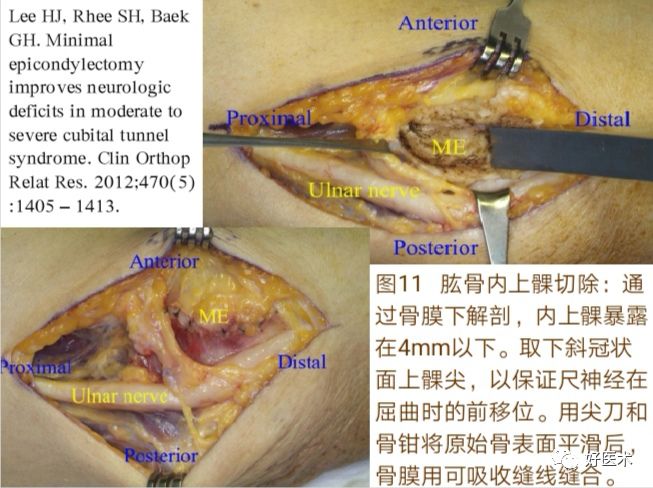 肘管综合征十大要点详解，帮你彻底整明白！