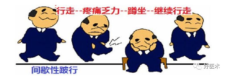 10分钟带您系统学习：腰椎间盘突出症！