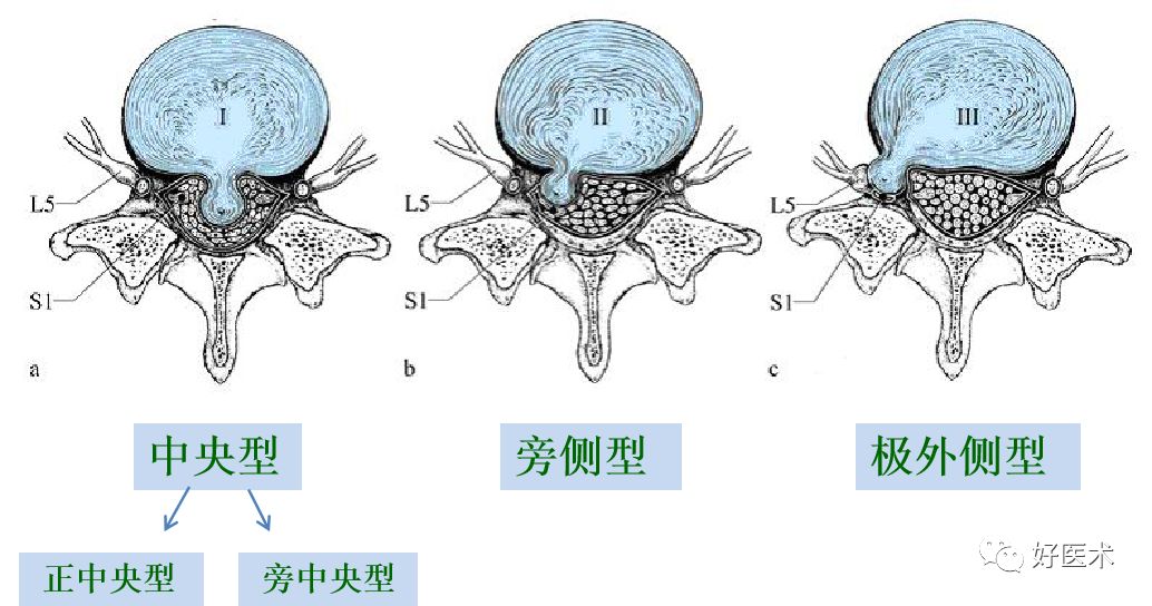 10分钟带您系统学习：腰椎间盘突出症！