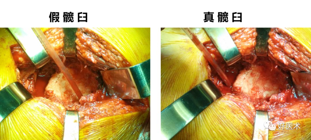 面对复杂初次髋关节置换，我们应如何应对？