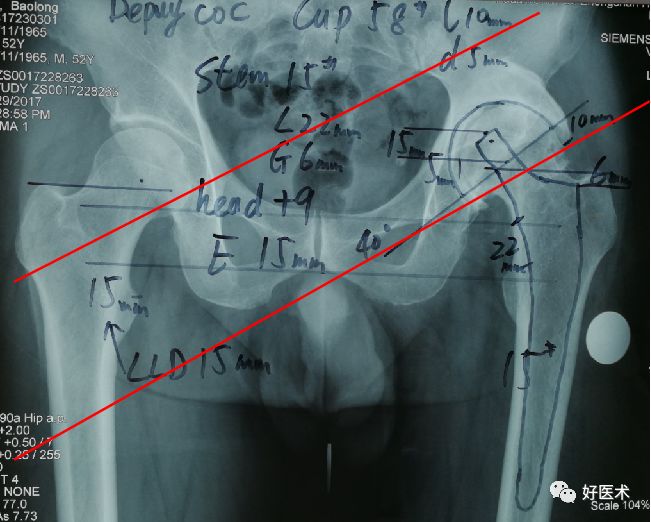 面对复杂初次髋关节置换，我们应如何应对？