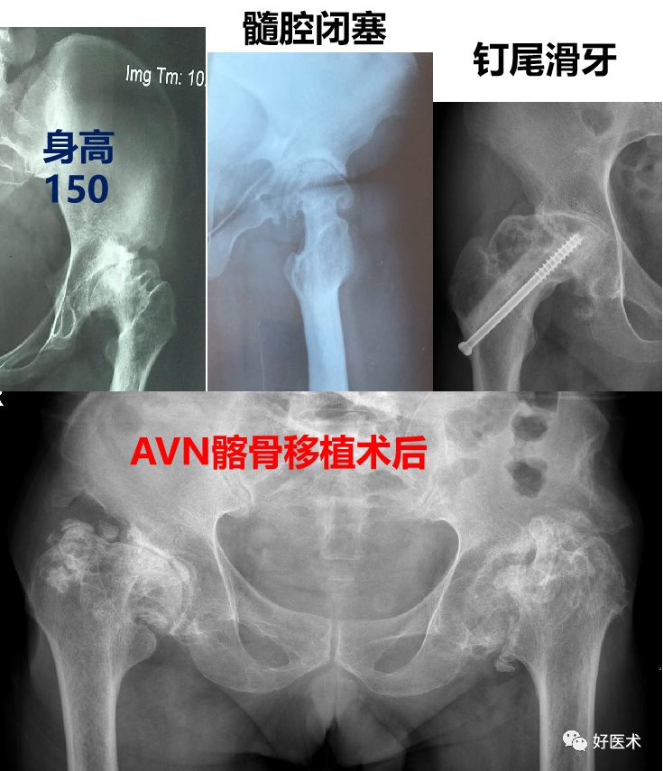 面对复杂初次髋关节置换，我们应如何应对？