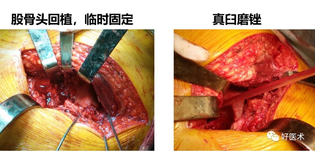 面对复杂初次髋关节置换，我们应如何应对？