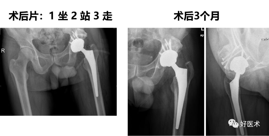 面对复杂初次髋关节置换，我们应如何应对？