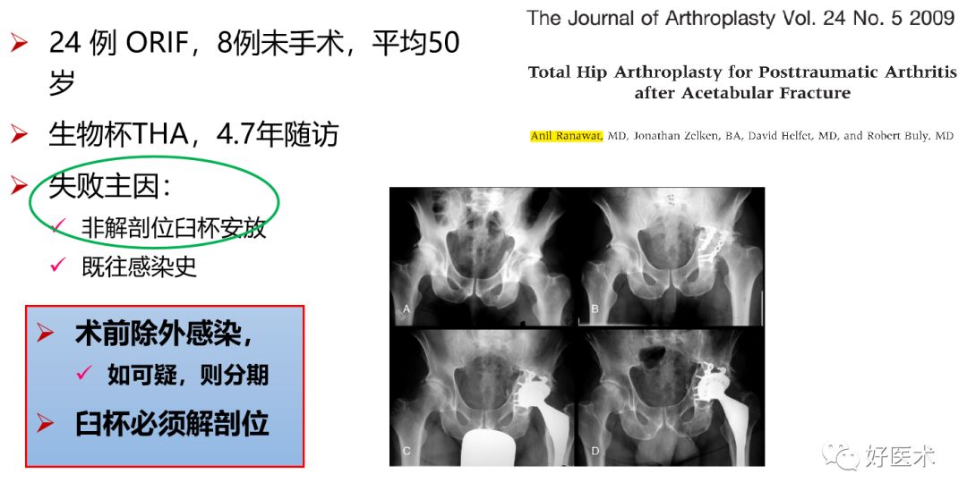 面对复杂初次髋关节置换，我们应如何应对？