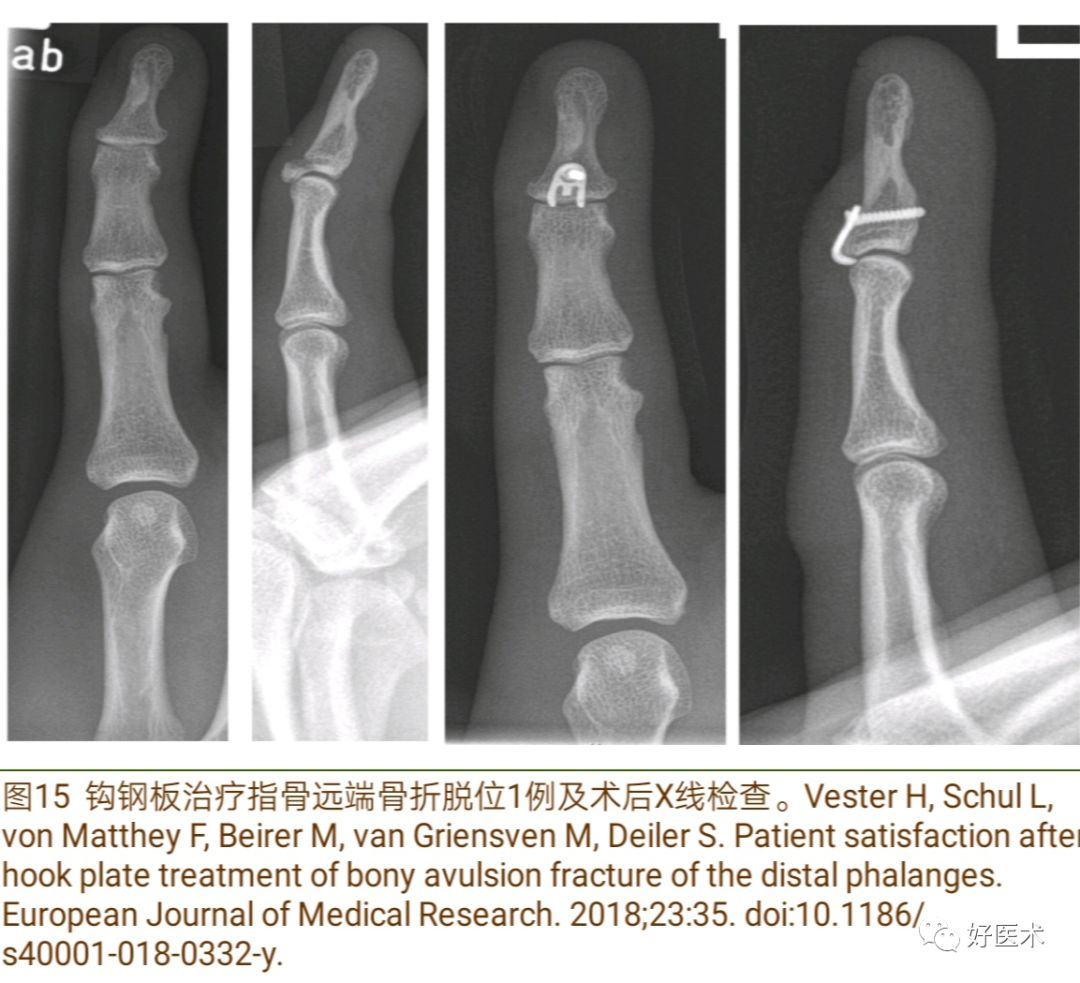 详解治疗锤状指的7种手术方法，你都掌握了吗？ - 好医术早读文章 - 好医术-赋能医生守护生命