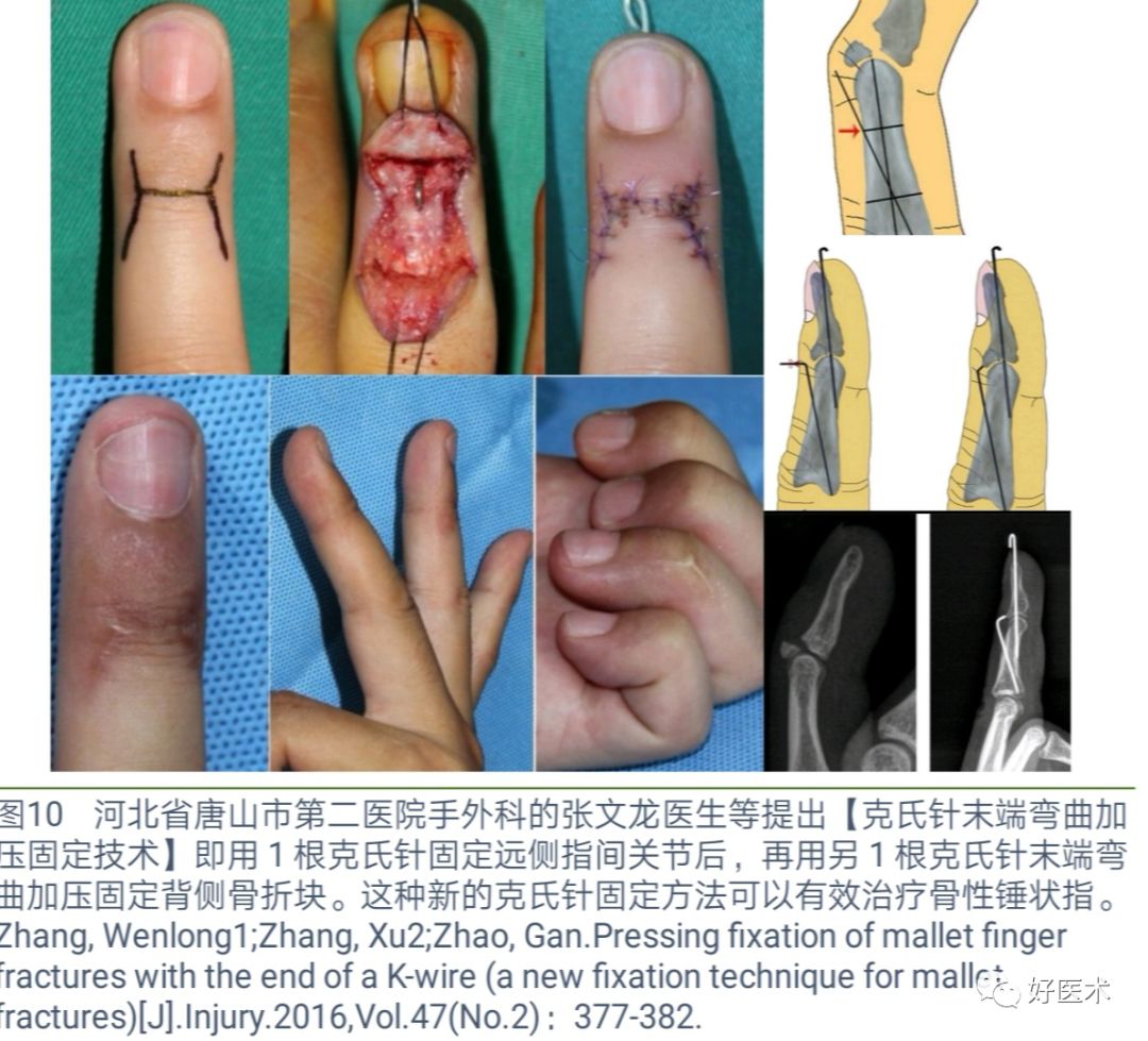 详解治疗锤状指的7种手术方法，你都掌握了吗？