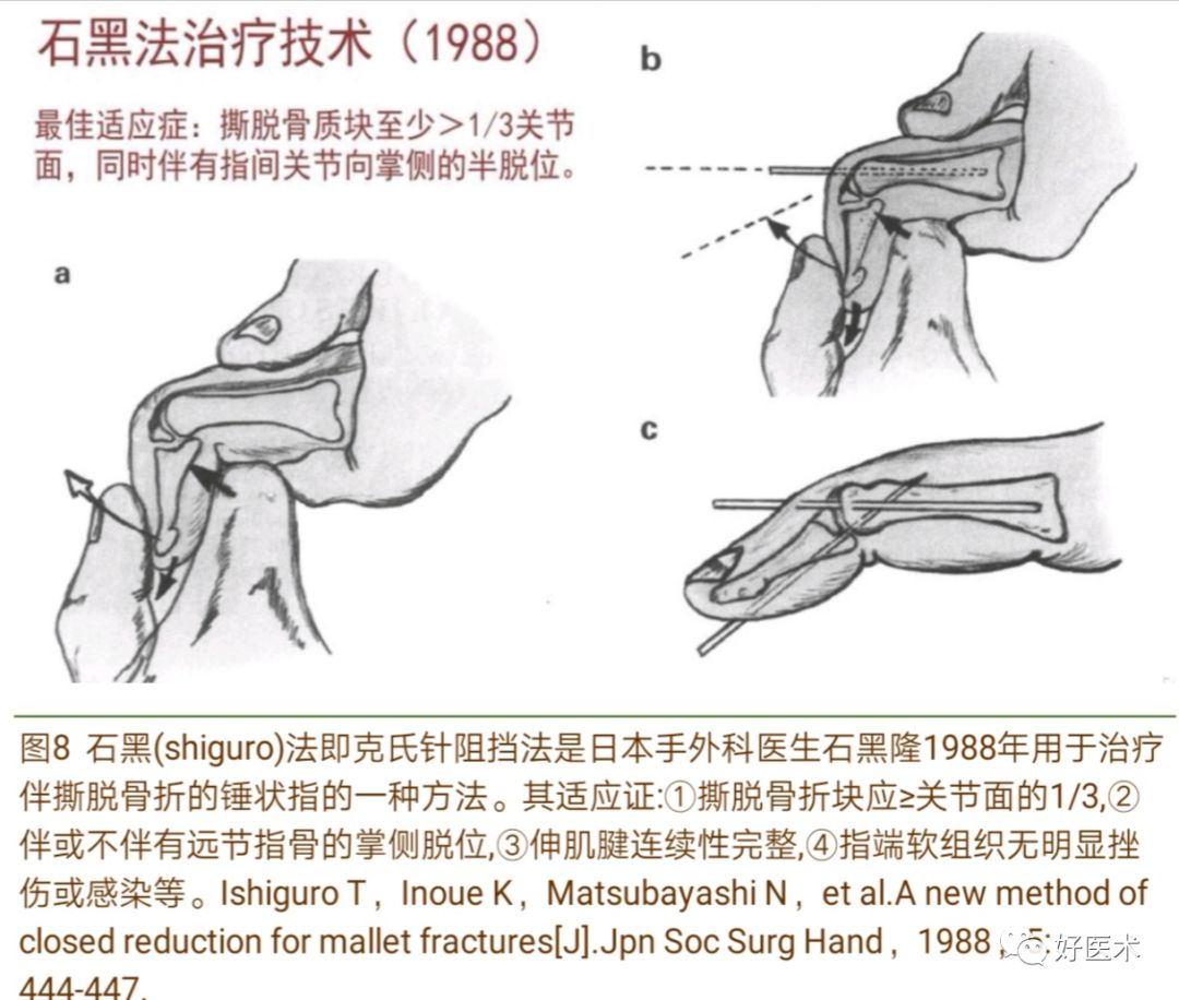 详解治疗锤状指的7种手术方法，你都掌握了吗？