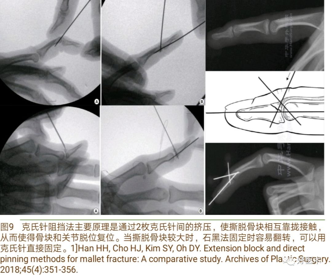 详解治疗锤状指的7种手术方法，你都掌握了吗？