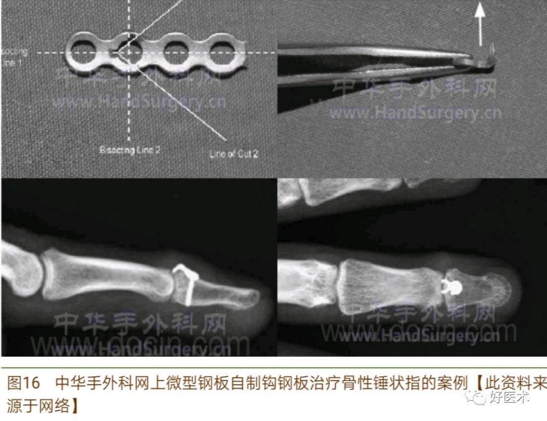 详解治疗锤状指的7种手术方法，你都掌握了吗？