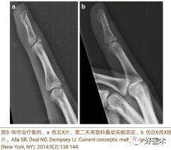 详解治疗锤状指的7种手术方法，你都掌握了吗？