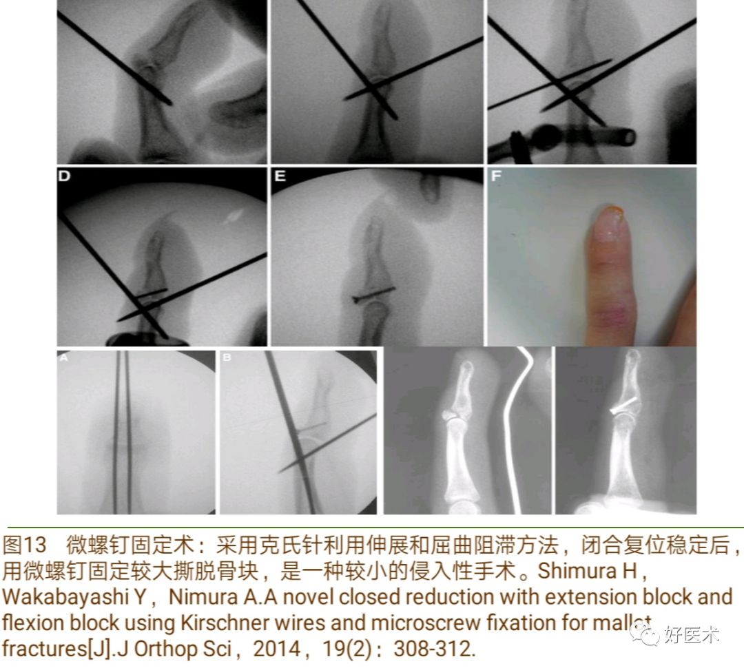 详解治疗锤状指的7种手术方法，你都掌握了吗？