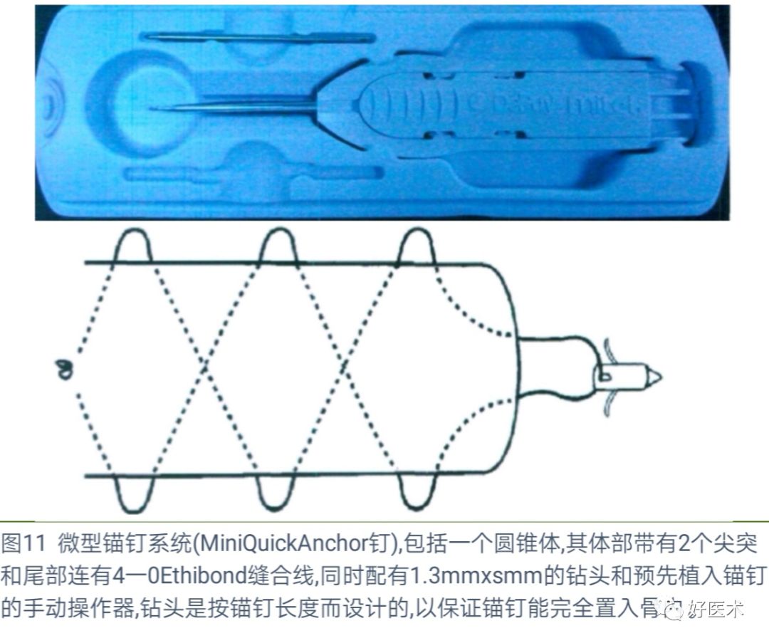 详解治疗锤状指的7种手术方法，你都掌握了吗？