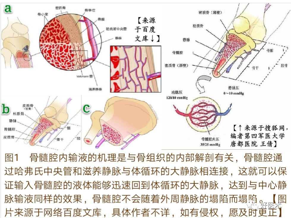 骨髓腔内输注技术要点详解，值得一看！