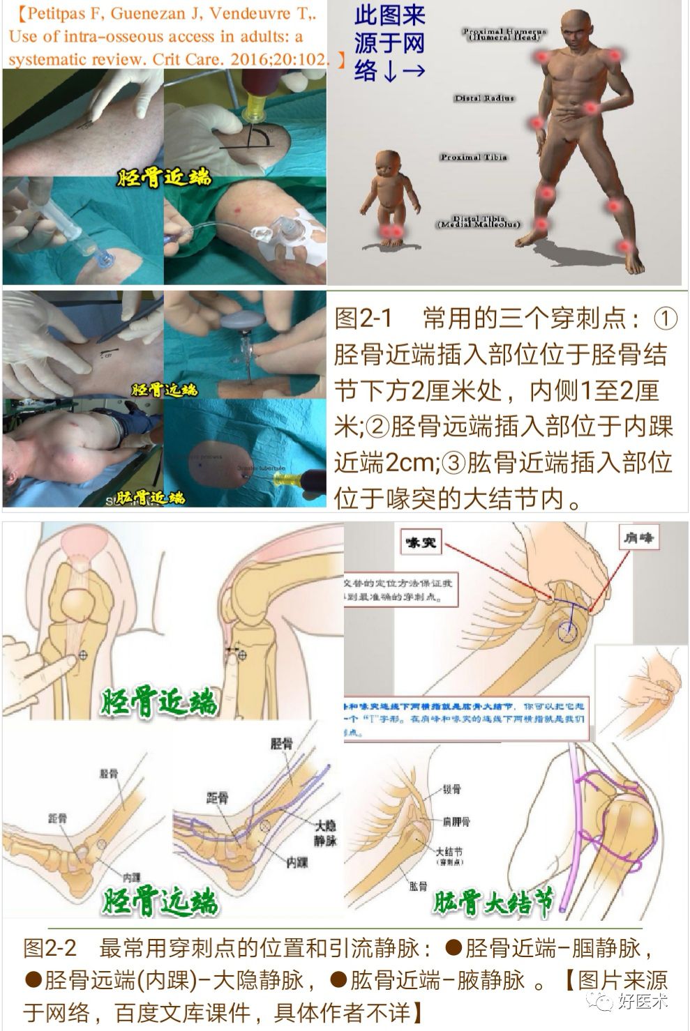 骨髓腔内输注技术要点详解，值得一看！