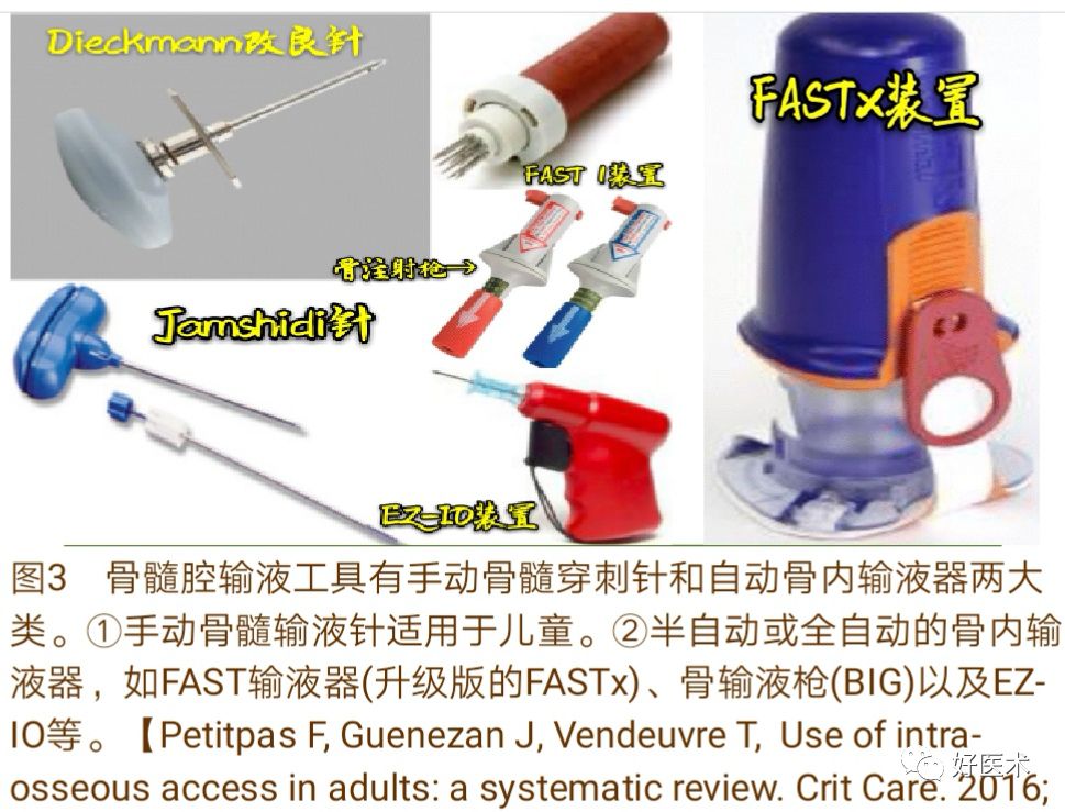 骨髓腔内输注技术要点详解，值得一看！