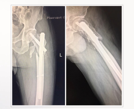 转子下骨折术后失败，原因详解与诊疗策略都在这篇！