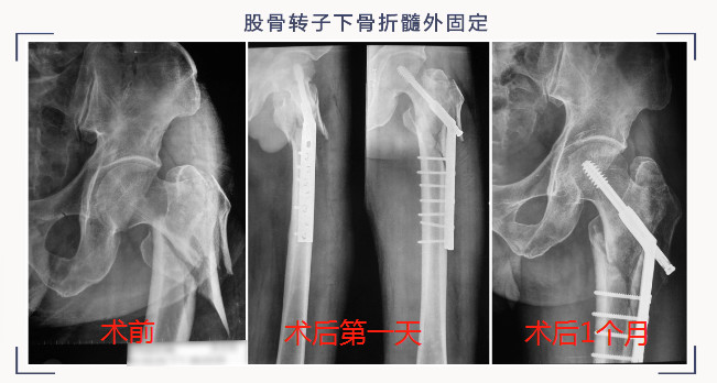 转子下骨折术后失败，原因详解与诊疗策略都在这篇！